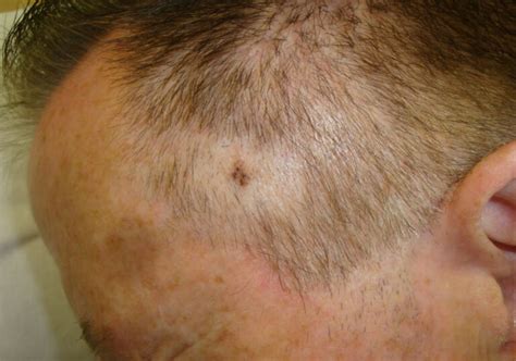 Melanoma on scalp pictures: early stage 1, scalp melanoma images, melanoma on neck pictures ...