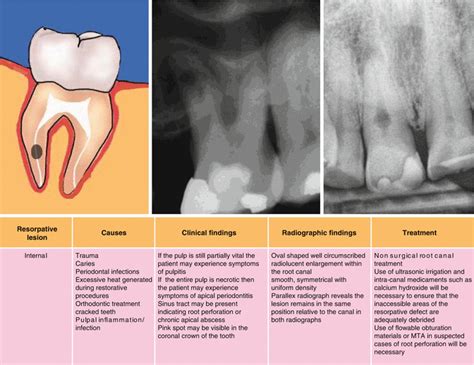 External Resorption Of Tooth