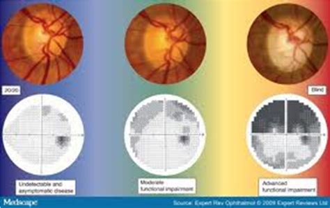 The Optic Nerve in Glaucoma | IntechOpen