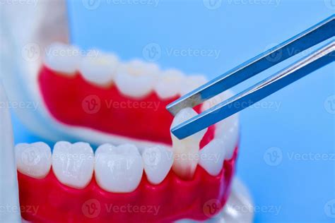 tweezers pulling tooth from the lower jaw model 11280915 Stock Photo at Vecteezy