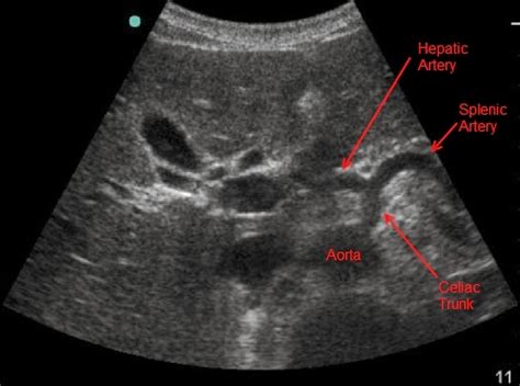 Radiology Anatomy Images : Celiac trunk ultrasound anatomy