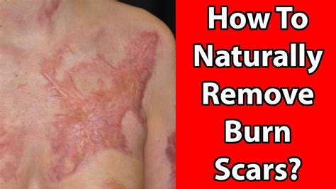 😀 😀 How To Naturally Remove Burn Scars? - Home Remedies to Remove Burn Scars 😀 😀 - YouTube