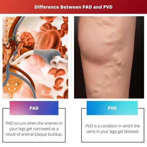 PAD vs PVD: Difference and Comparison