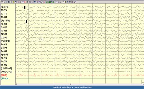 Jacksonian seizures | MedLink Neurology