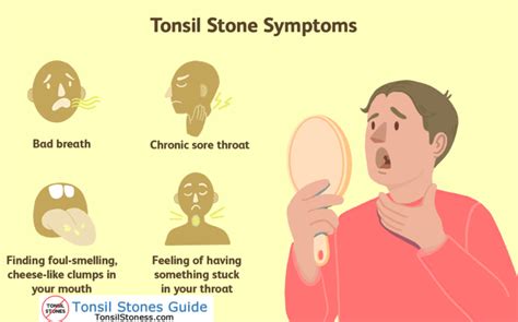 Are Tonsil Stones Good or Bad? [2022]