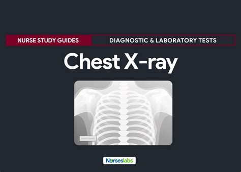 Chest X-ray (Chest Radiography) - Nursing Responsibilities - Nurseslabs