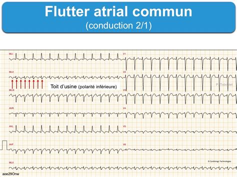 Flutter atrial 1. Généralités : e-cardiogram