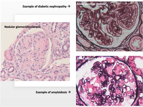 Nodular Glomerulosclerosis – Not All Are Created Equal – AJKD Blog