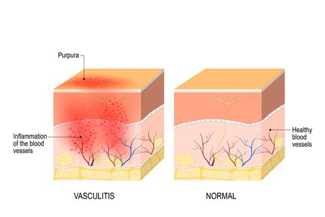 The Connection Between Lupus and Vasculitis