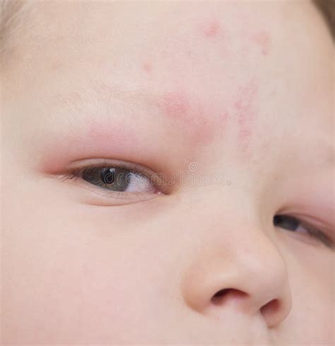 Allergy after mosquitoes stock photo. Image of infection - 70940050