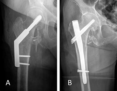 Intertrochanteric Fracture | Orthopaedic Trauma Association (OTA)