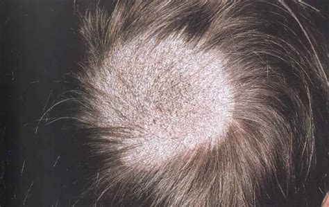 Ringworm on Scalp Causes, Symptoms, Treatment - Scalp Ringworm Pictures - eMedicineHealth