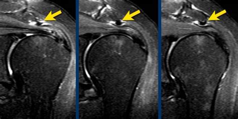 Supraspinatus Tear Mri