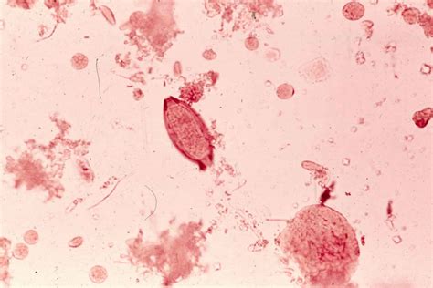 Trichuriasis causes, prevention, symptoms, diagnosis & treatment