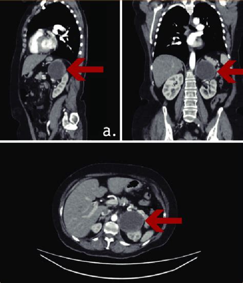 Admission CT-aortogram with contrast demonstrating 6.6cm thick-walled ...