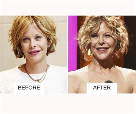 25 Most Popular Celebrities With Lip Fillers: Before And After With Images | Fabbon