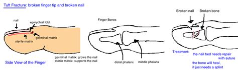 Hand - Nailbed & Finger Tip Injury — Bone Talks