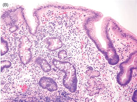 Chapter 10 – Histology of Gastroesophageal Reflux Disease and Barrett’s ...