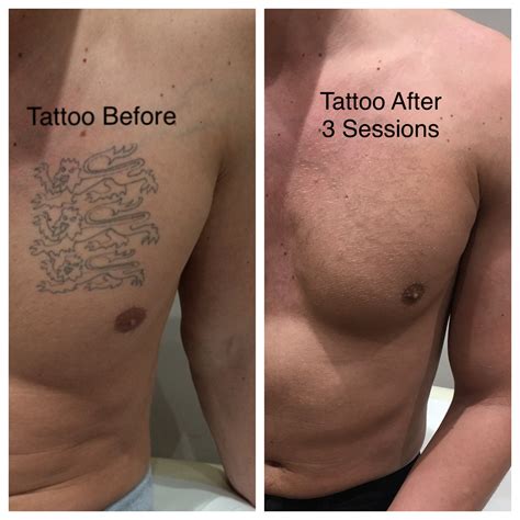 Tattoo Removal Treatment Laser - Free Tattoo Ideas