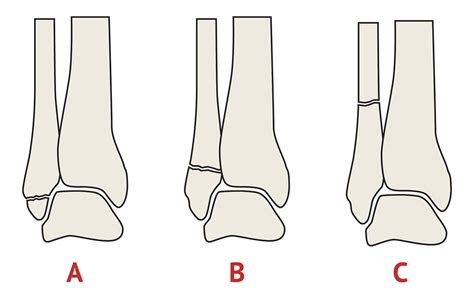 Weber Classification | Orthopaedic X-Ray Interpretation - MedSchool