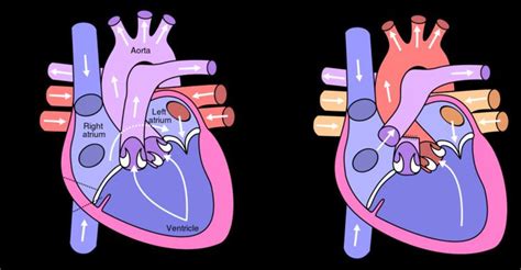 Fontan procedure - Alchetron, The Free Social Encyclopedia