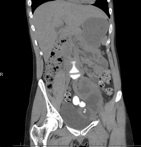 Robotic pyelolithotomy in a solitary pelvic kidney complicated with fulminant Clostridium ...