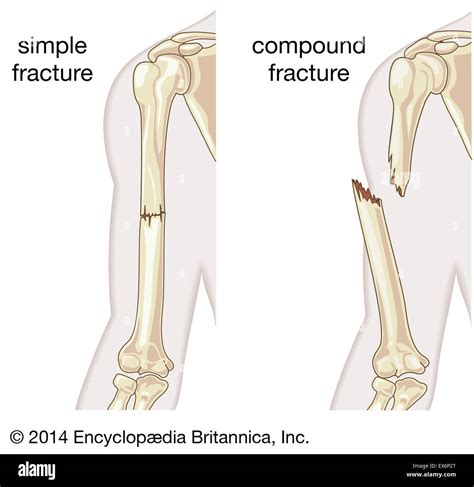 Simple and compound fracture Stock Photo - Alamy