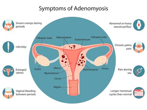 Premium Vector | Adenomiosis Symptoms infographic Detailed vector Infographic Women Health