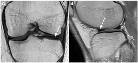 Horizontal Meniscal Tear Mri