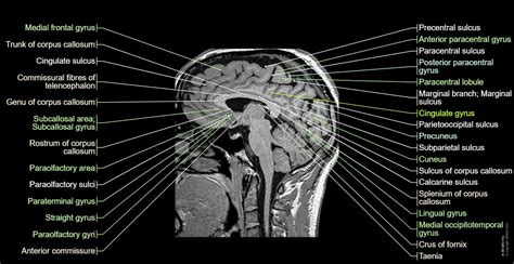 Normal Mri Brain