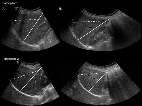 Liver Measurement Ultrasound