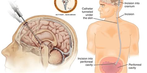 Best Hydrocephalus treatment in Guntur - Dr Rao's Hospitals