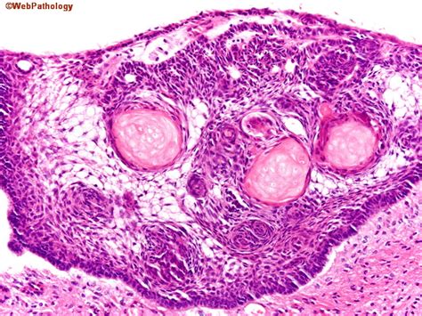 Craniopharyngioma Histology