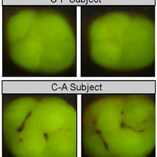 Caries Phenotype Determination. Quantitative Light fluorescence (QLF ...