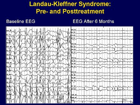 Landau-Kleffner Syndrome: Link to medscape; SPECIAL SYNDROMES OF STATUS ...