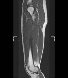 Normal MRI of the thigh | Image | Radiopaedia.org