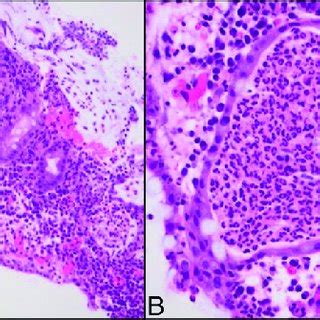 Colonoscopy showing (A) pseudopolyps in the descending colon and (B)... | Download Scientific ...