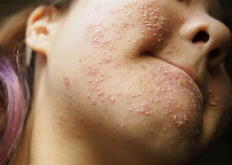 Allergic Reaction Rash - Pictures, Causes, Treatment, Symptoms - (2018 - Updated)