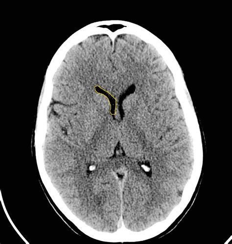 CT Head Normal Anatomy