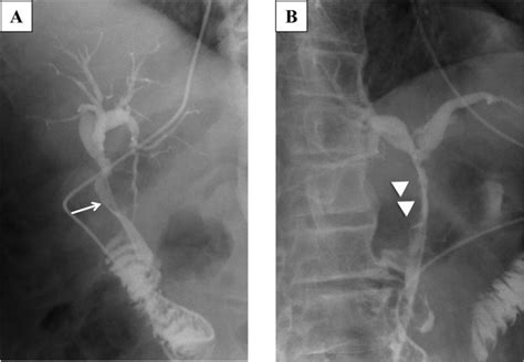 Preoperative cholangiography through an ENBD tube. Preoperative... | Download Scientific Diagram