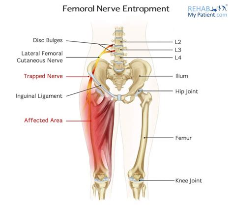 Pin on FEMORAL NERVE PINCHED