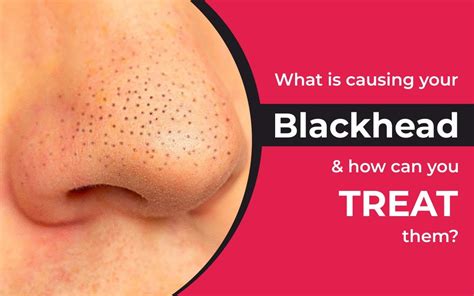 What Are The Causes Of Blackheads And How To Treat Them