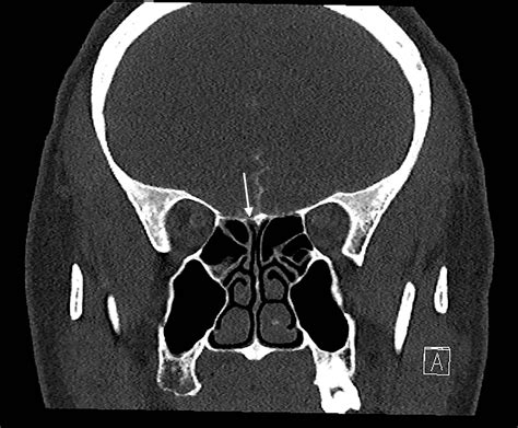 Cureus | A Rare Case of Spontaneous Recurrent Cerebrospinal Fluid Rhinorrhea