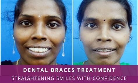 Dental Braces Treatment – Straightening Smiles with Confidence ...