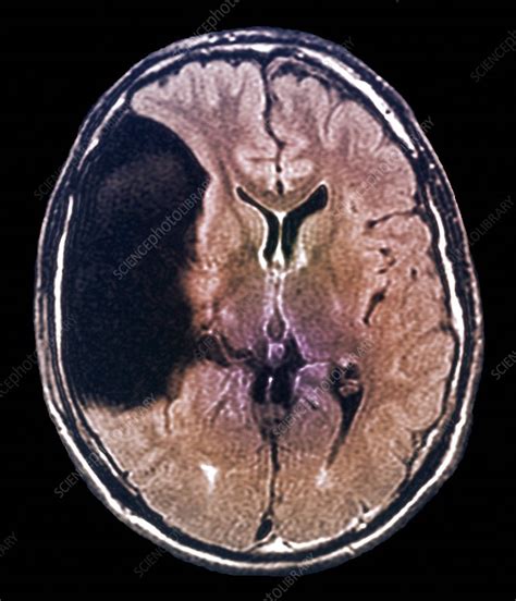 Arachnoid cyst in the brain, MRI scan - Stock Image - C004/1414 ...