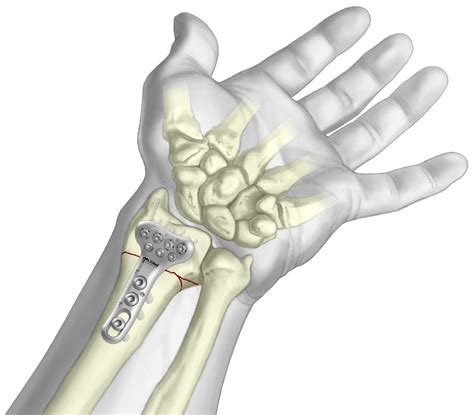 Volar Bearing Plate - Wrist Fracture Treatment - TriMed Inc.