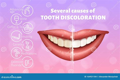 Medical Poster Showing Causes Of Tooth Discoloration. Educational Infographic Concept. Realistic ...