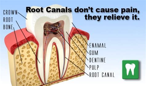 Root canals don't cause pain, they relieve it. - Bellingham Dental ...