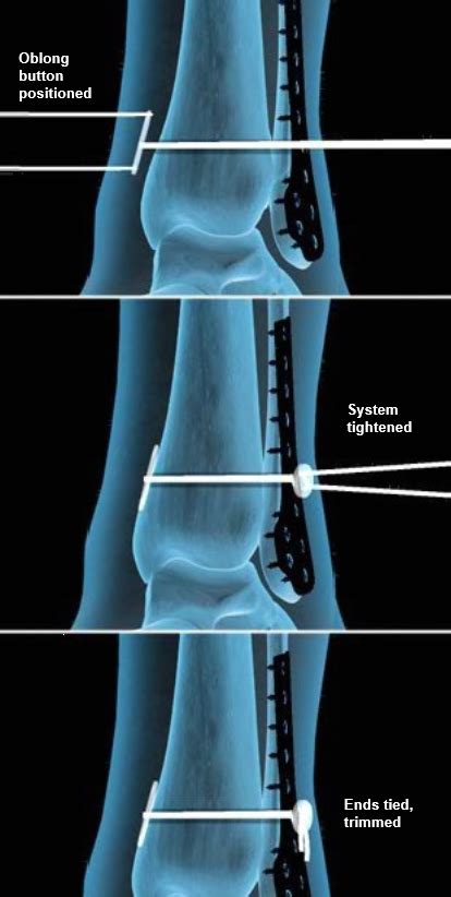 TightRope™ Fixation for Ankle Syndesmosis | Central Coast Orthopedic ...