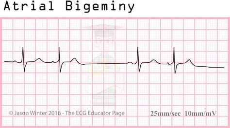 ECG Educator Blog : Atrial Rhythms